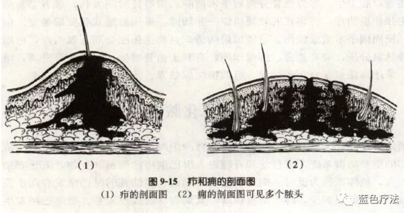 【蓝疗科普】毛囊炎,疖,痈,皮脂腺囊肿怎么区分?