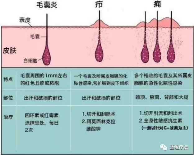 【蓝疗科普】毛囊炎,疖,痈,皮脂腺囊肿怎么区分?